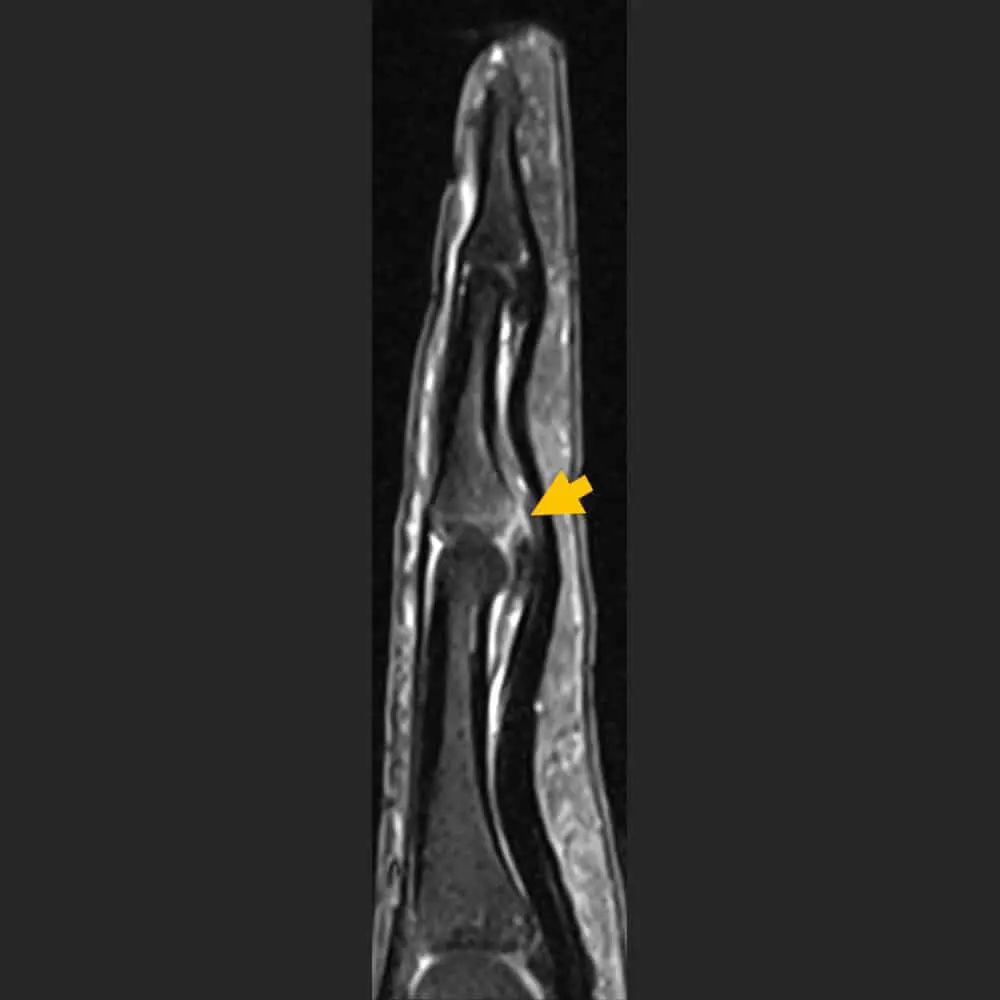 MRI scan of a finger at ARISTRA