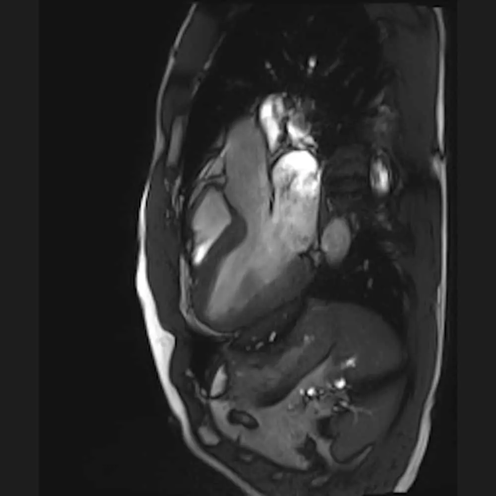Cardiac MRI at ARISTRA lateral view