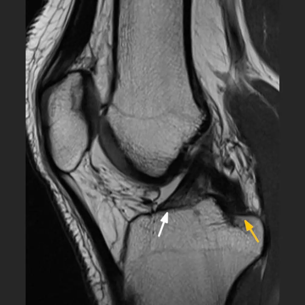 MRI scan of the Knee and Meniscus » Procedure and pictures
