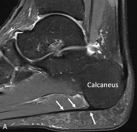MRI ankle joint, normal platar fascia