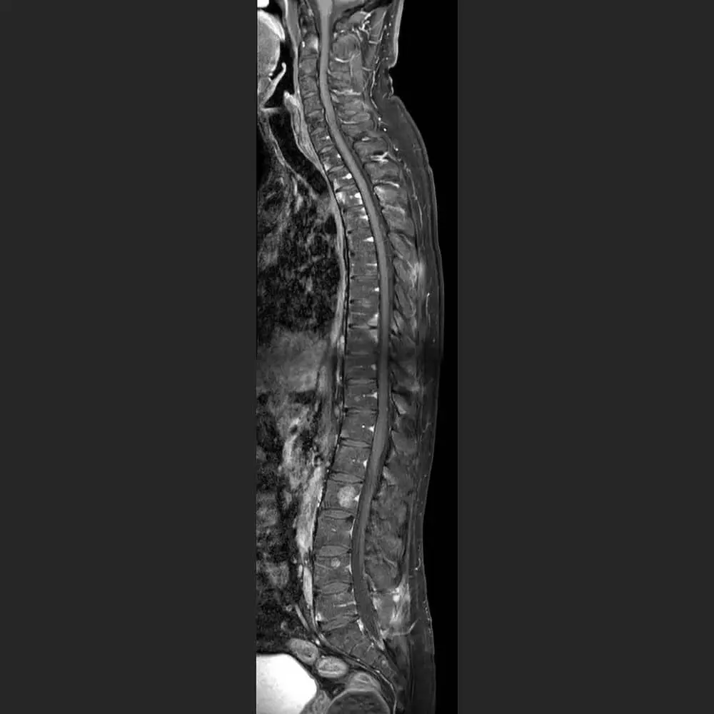 MRI of the spine taken with the Bekhterev protocol