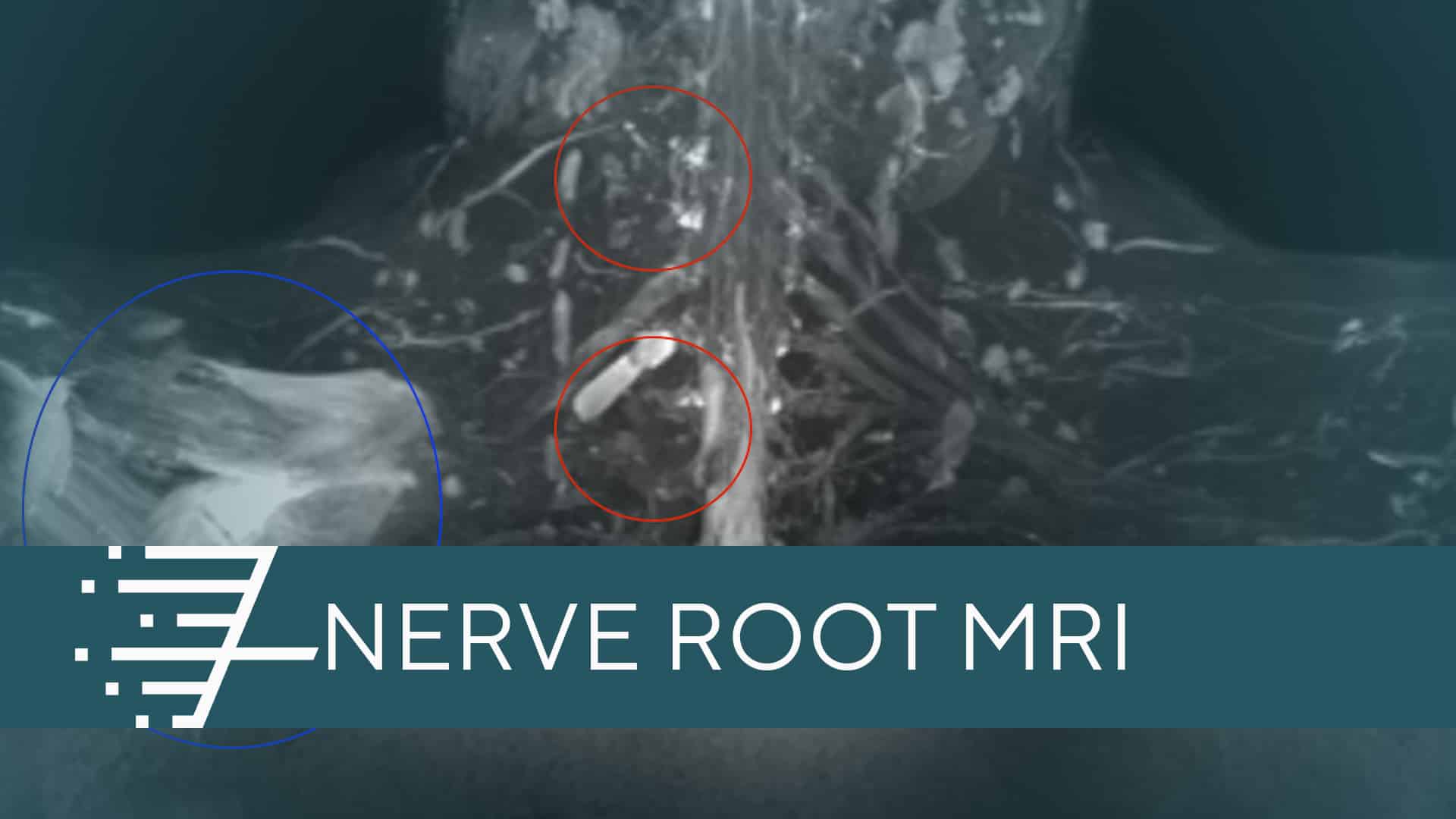 Nerve Root MRI Title Picture