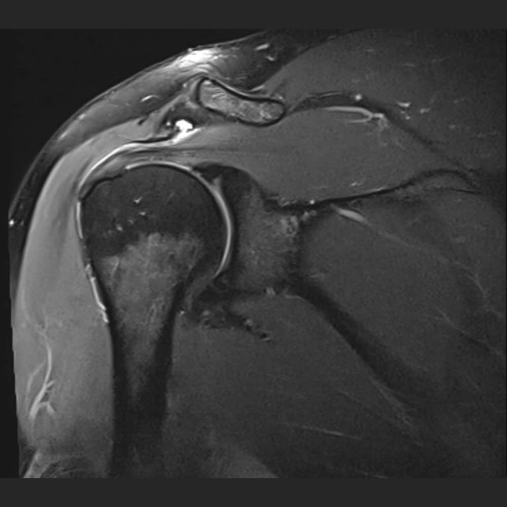 MRI image of a shoulder with mild bursitis