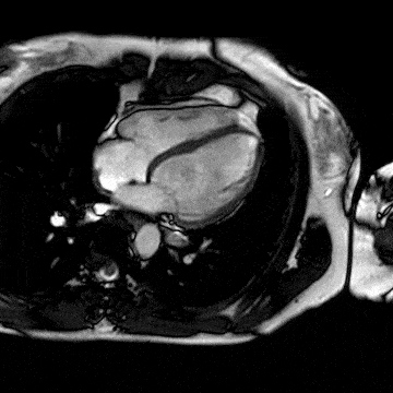 Example animation of a high-resolution MRI scan of the heart