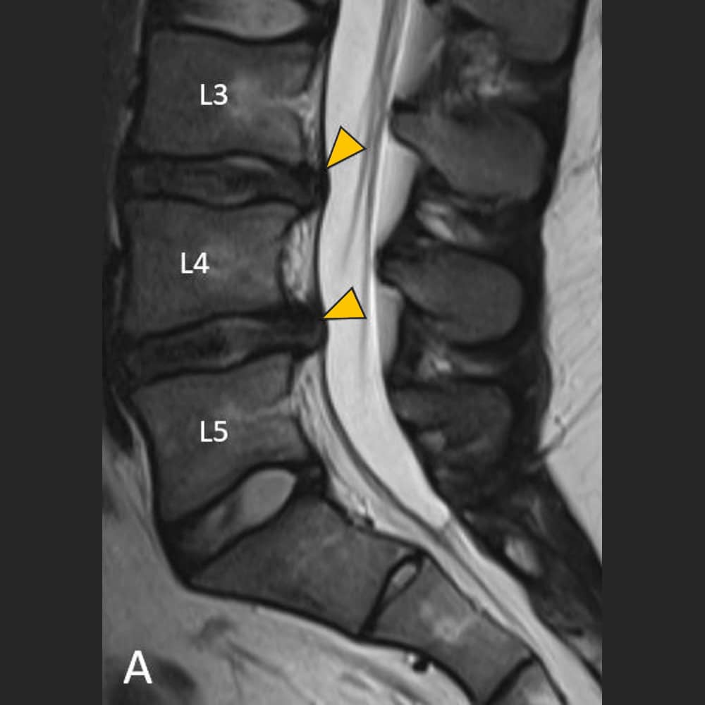 Disc protrusion of the lumbar spine in MRI, lateral view