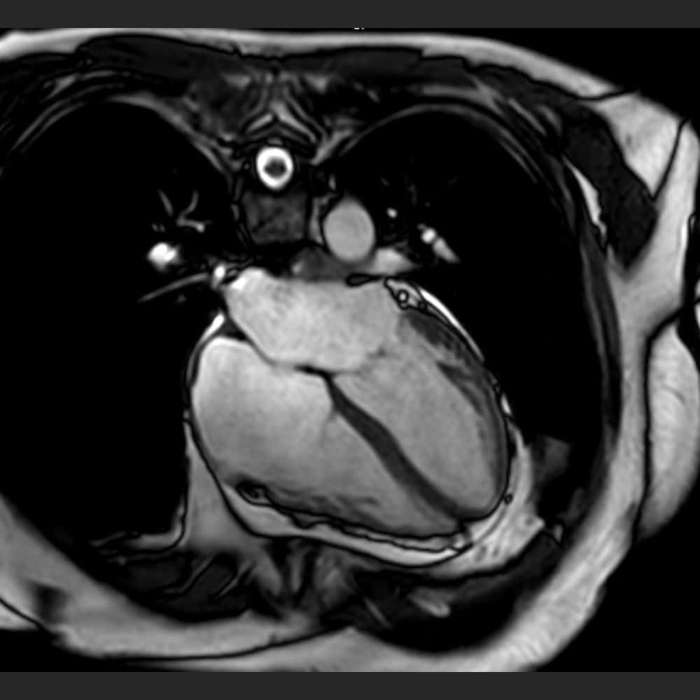 Cardio-MRI at ARISTRA. Cross section of the heart