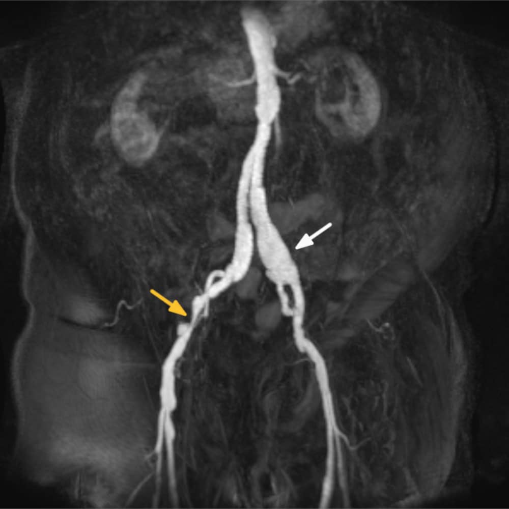 MR angiography with constriction in MRI