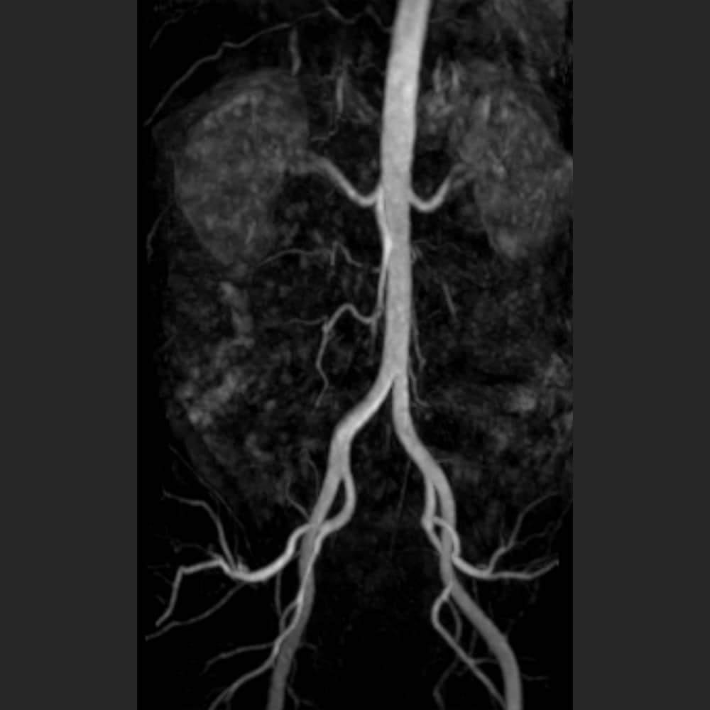 MR angiography via MRI image