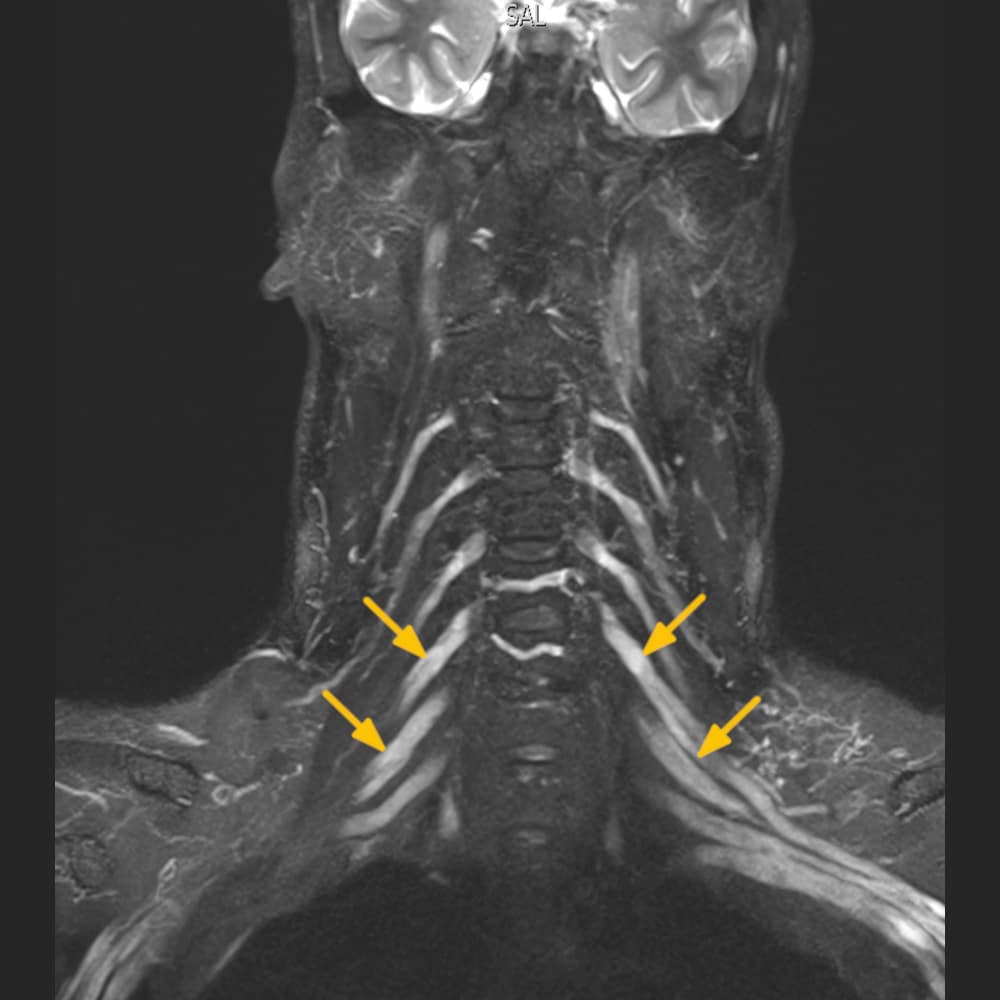 MRI image of the peripheral brachial plexus