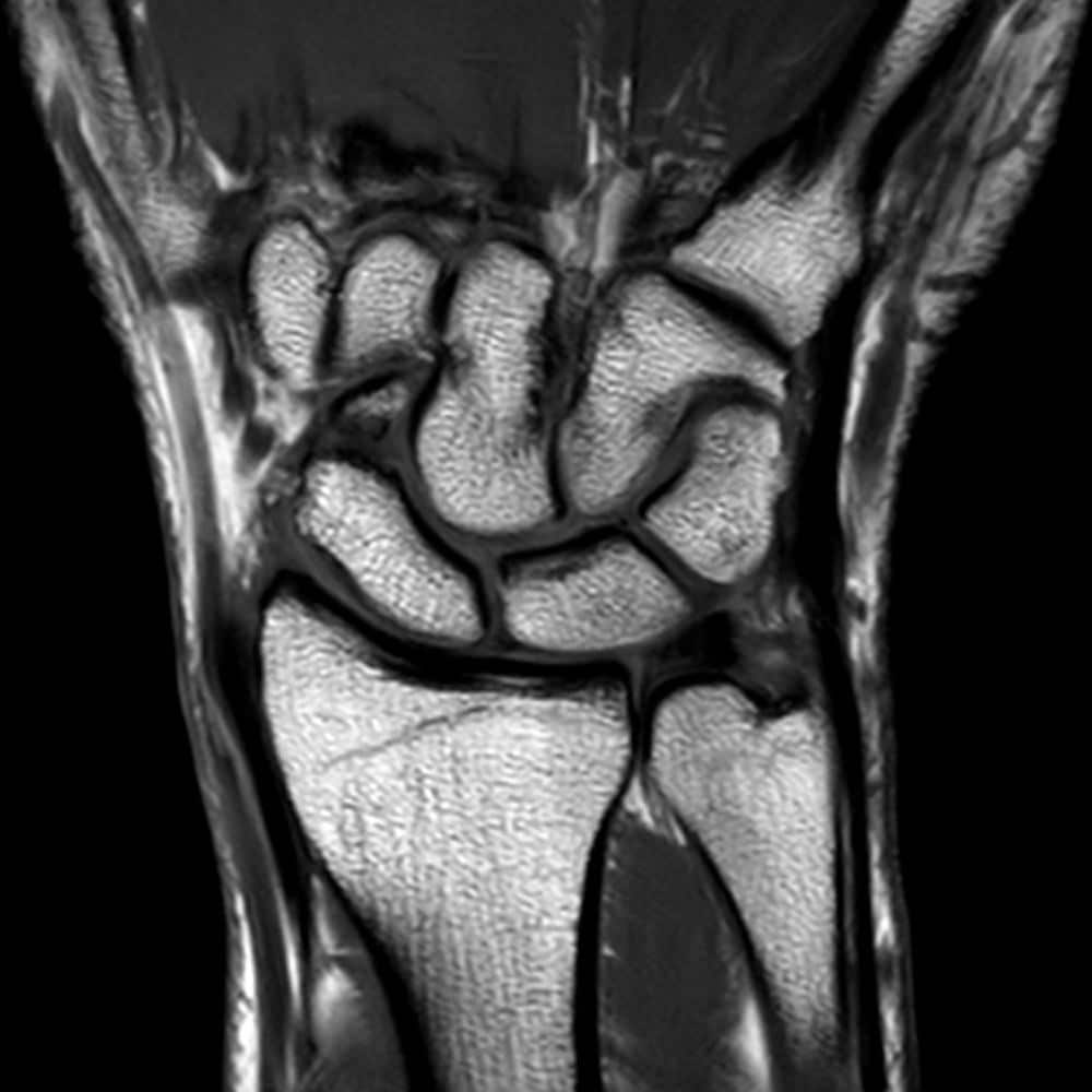 MRI scan of the wrist