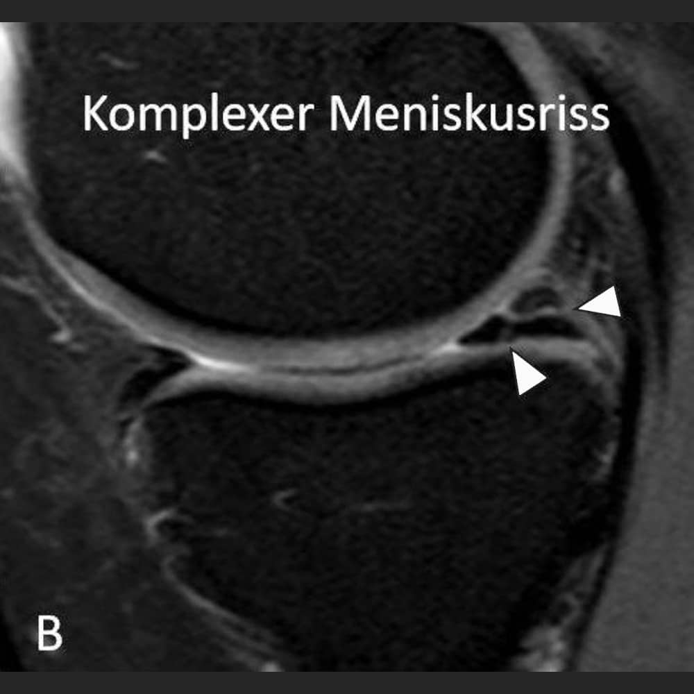 MRI image of a meniscus tear