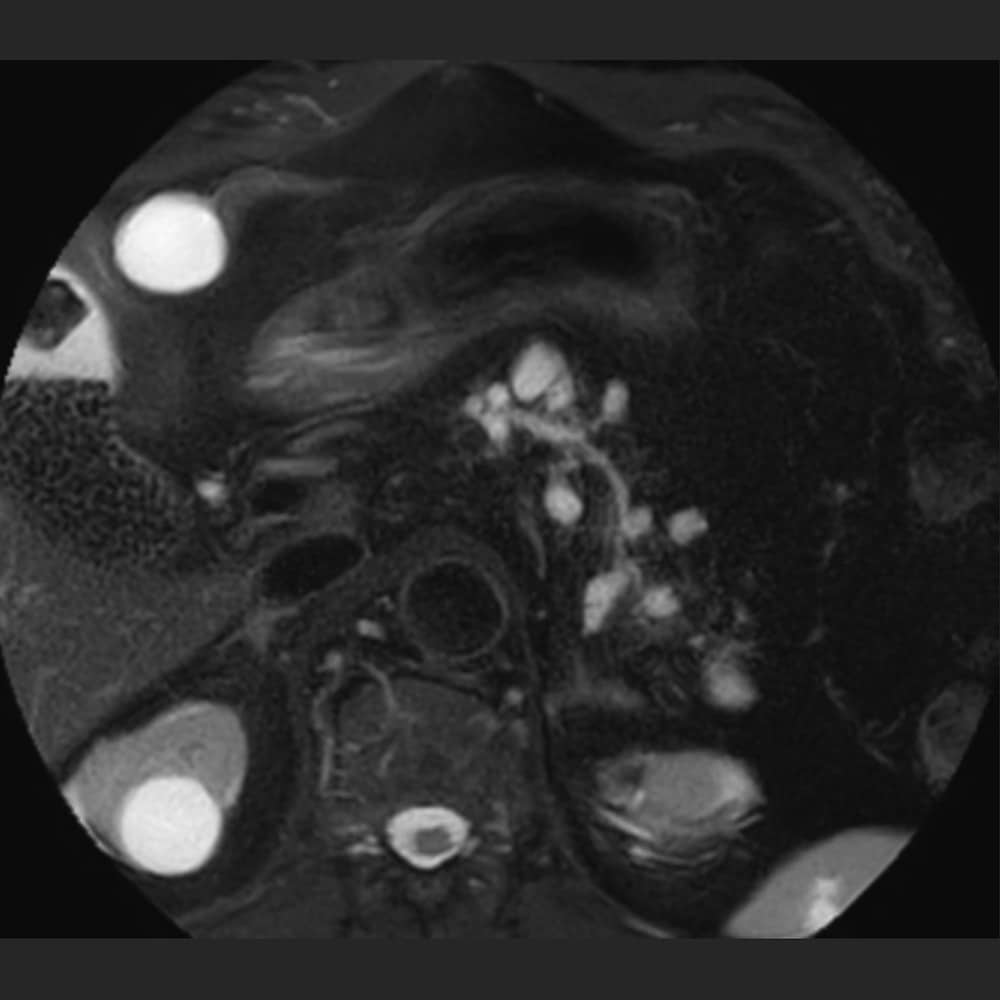 MRI scan of the pancreas