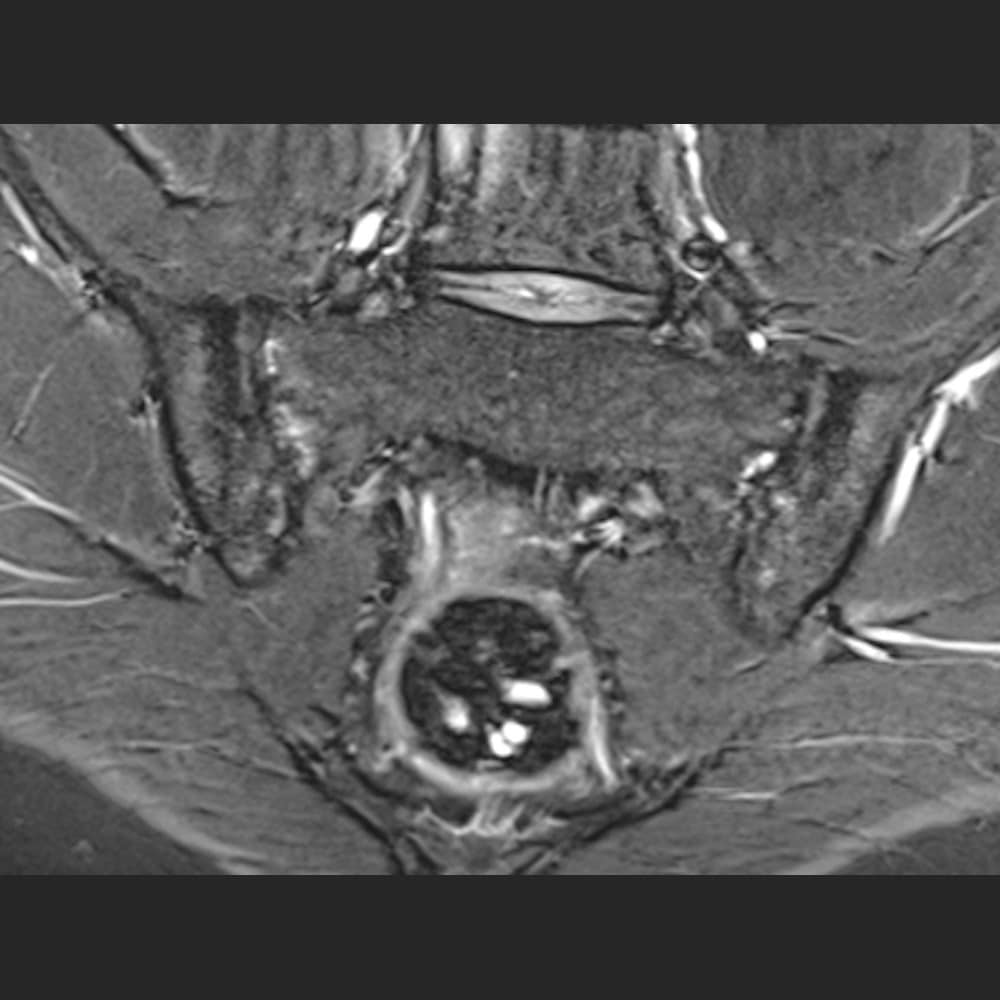 MRI scan of the pelvis at ARISTRA