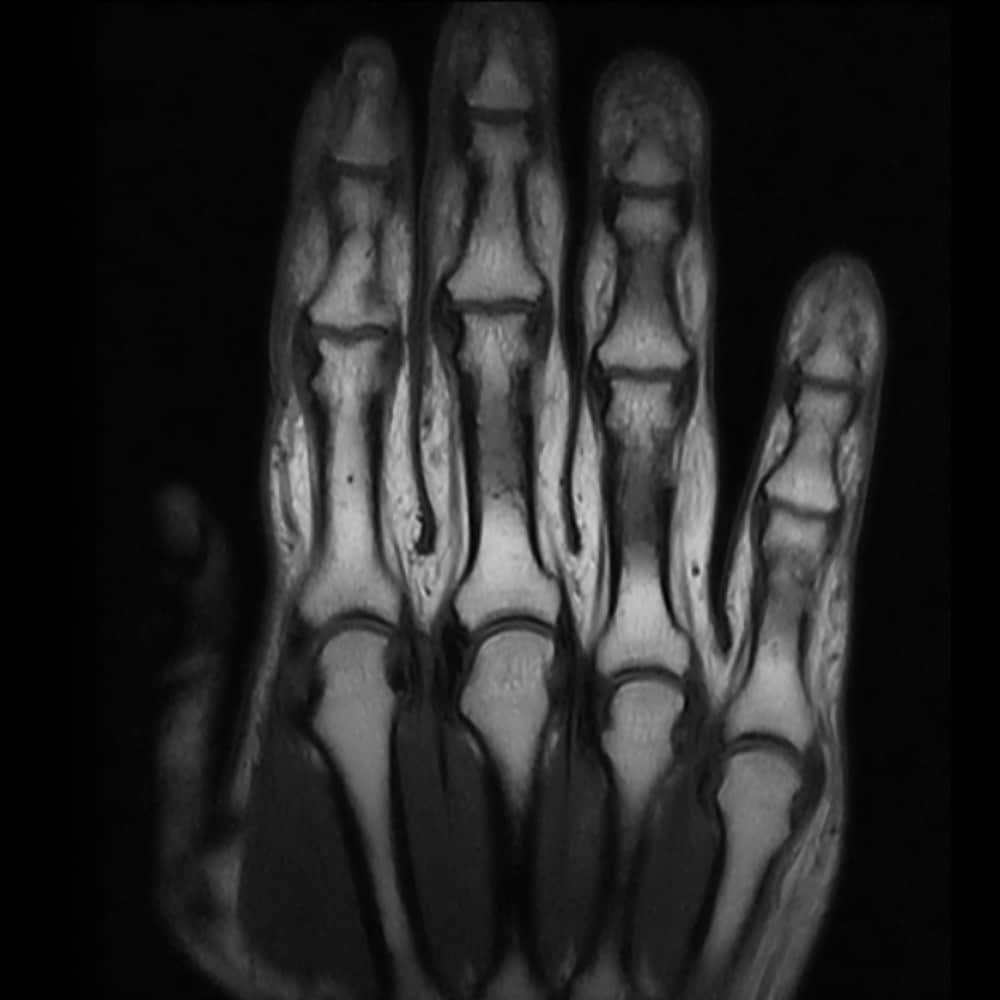 MRI scan of the wrist