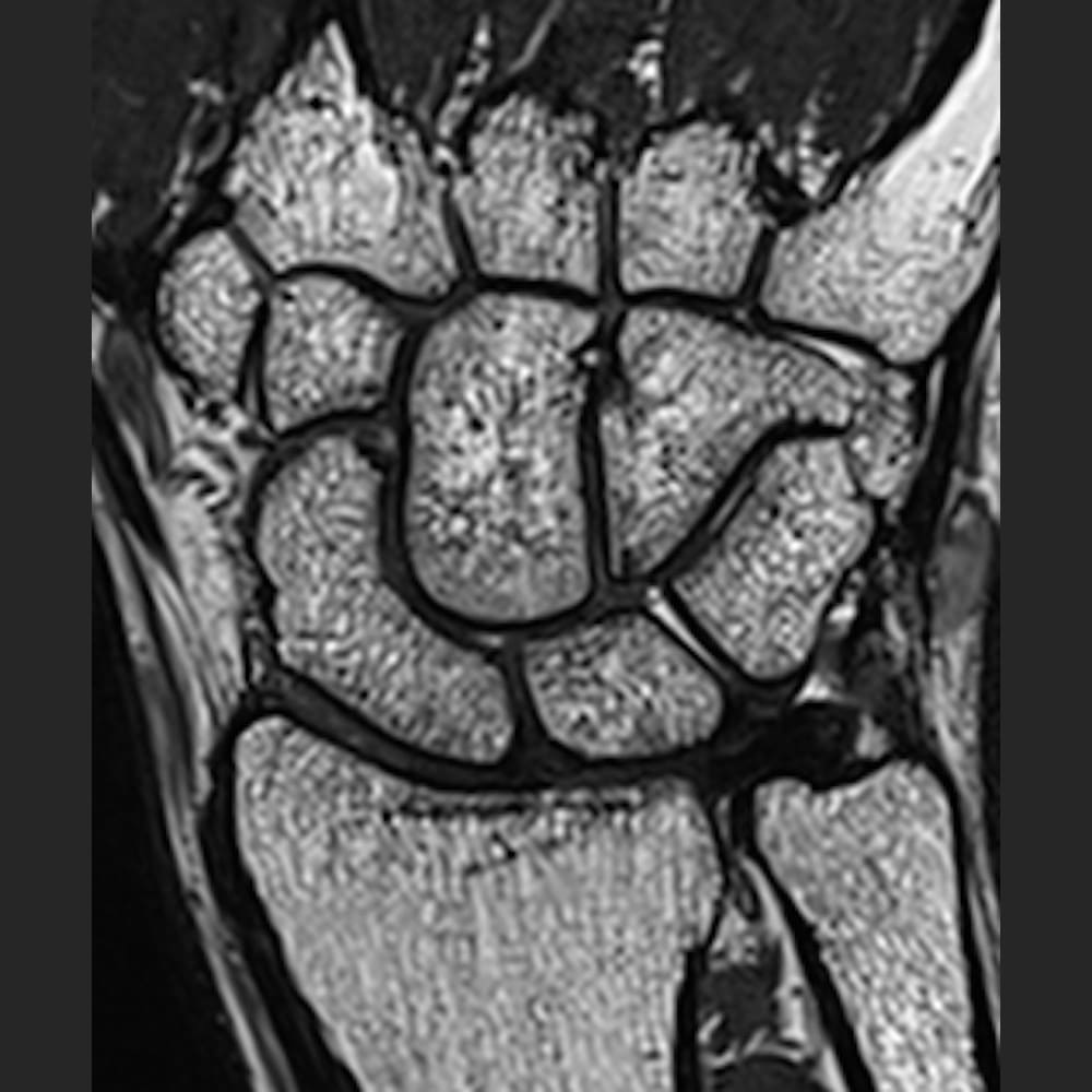 MRI image of the wrist at ARISTRA