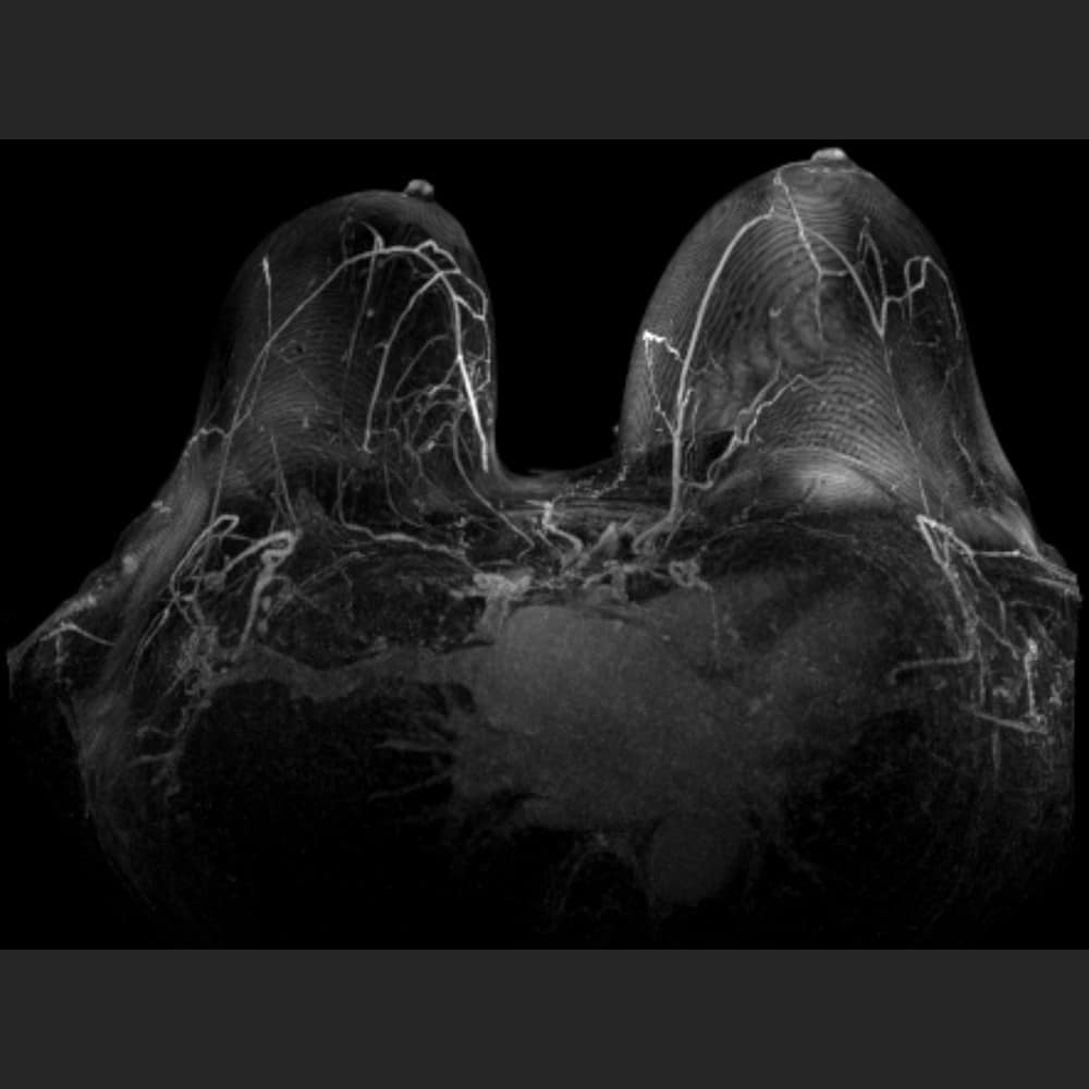 MRI scan of the breast at ARISTRA