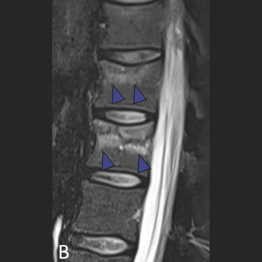 MRI thoracic spine lateral view with stress response