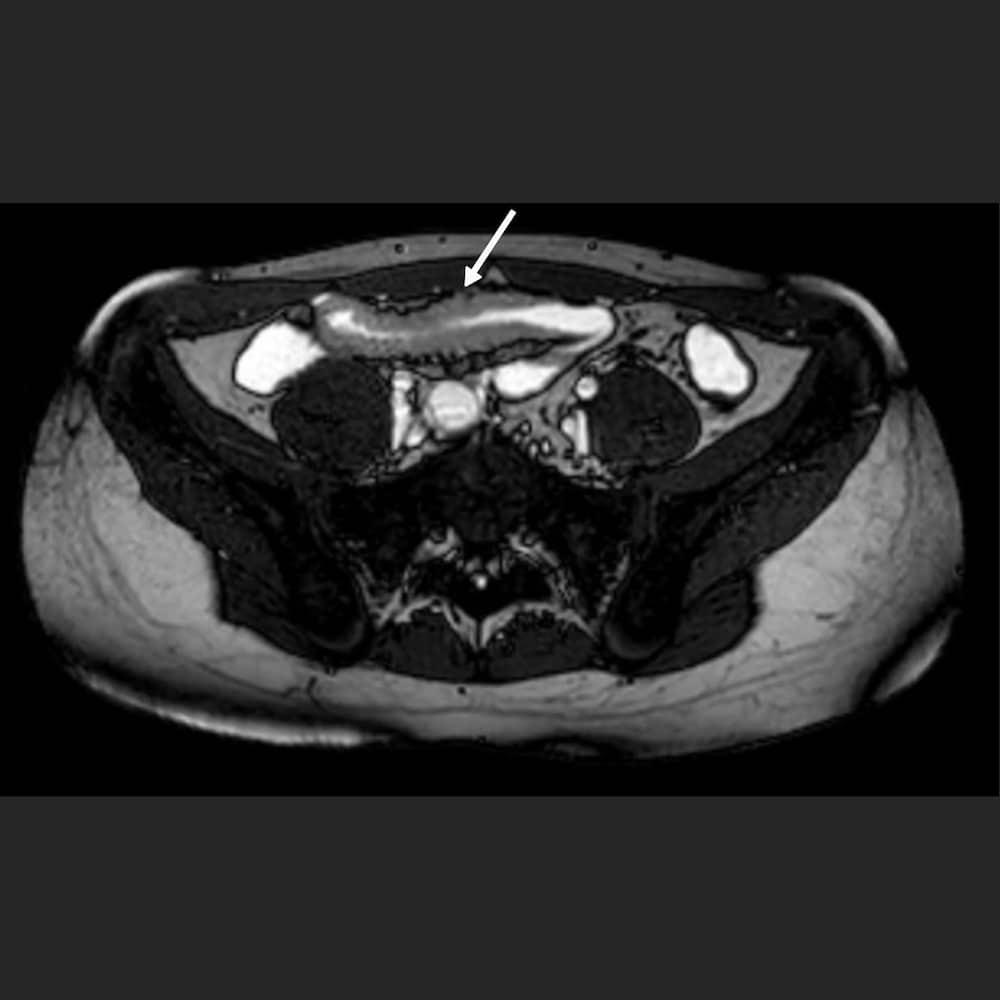 MRI abdomen. Cross section of the small intestine