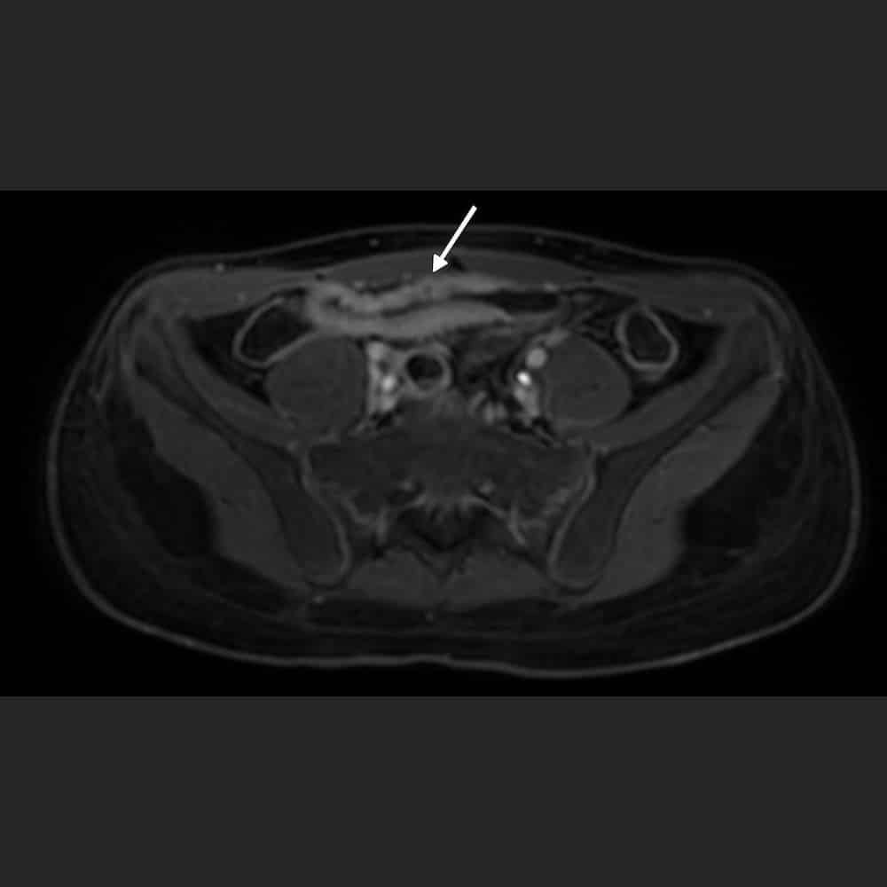 MRI abdomen. Cross-section of the small intestine