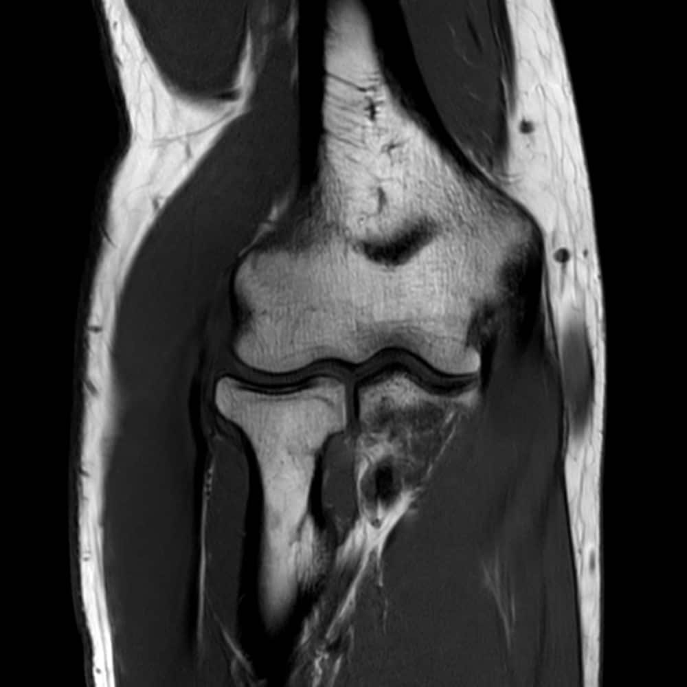 Image of elbow MRI at ARISTRA