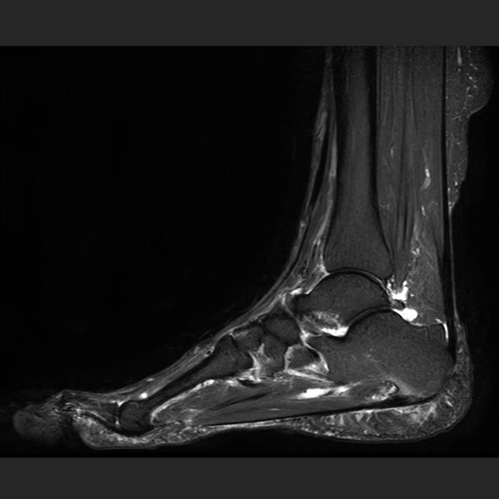 MRI scan of the foot at ARISTRA