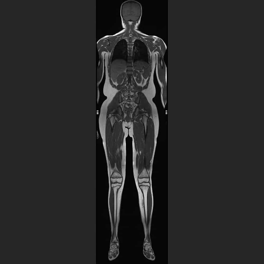 Example of a whole body scan - T1 sequence