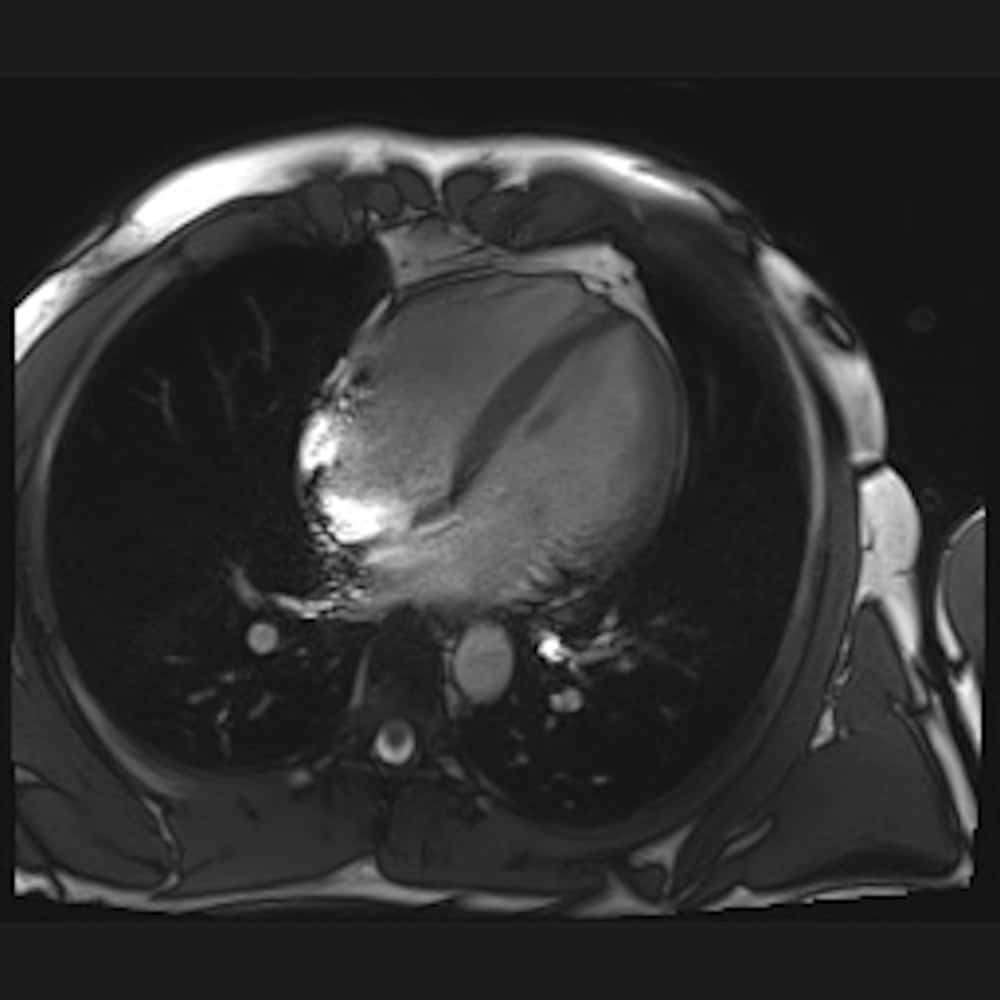 MRI image of the heart