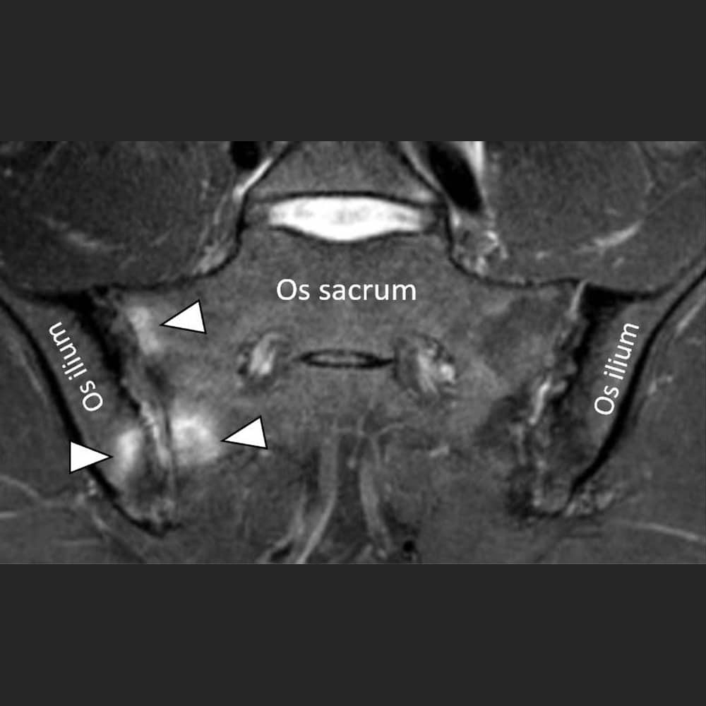 MRT-Aufnahme einer Entzündung (Arthritis) des Iliosakralgelenkes bei M. Bechterew