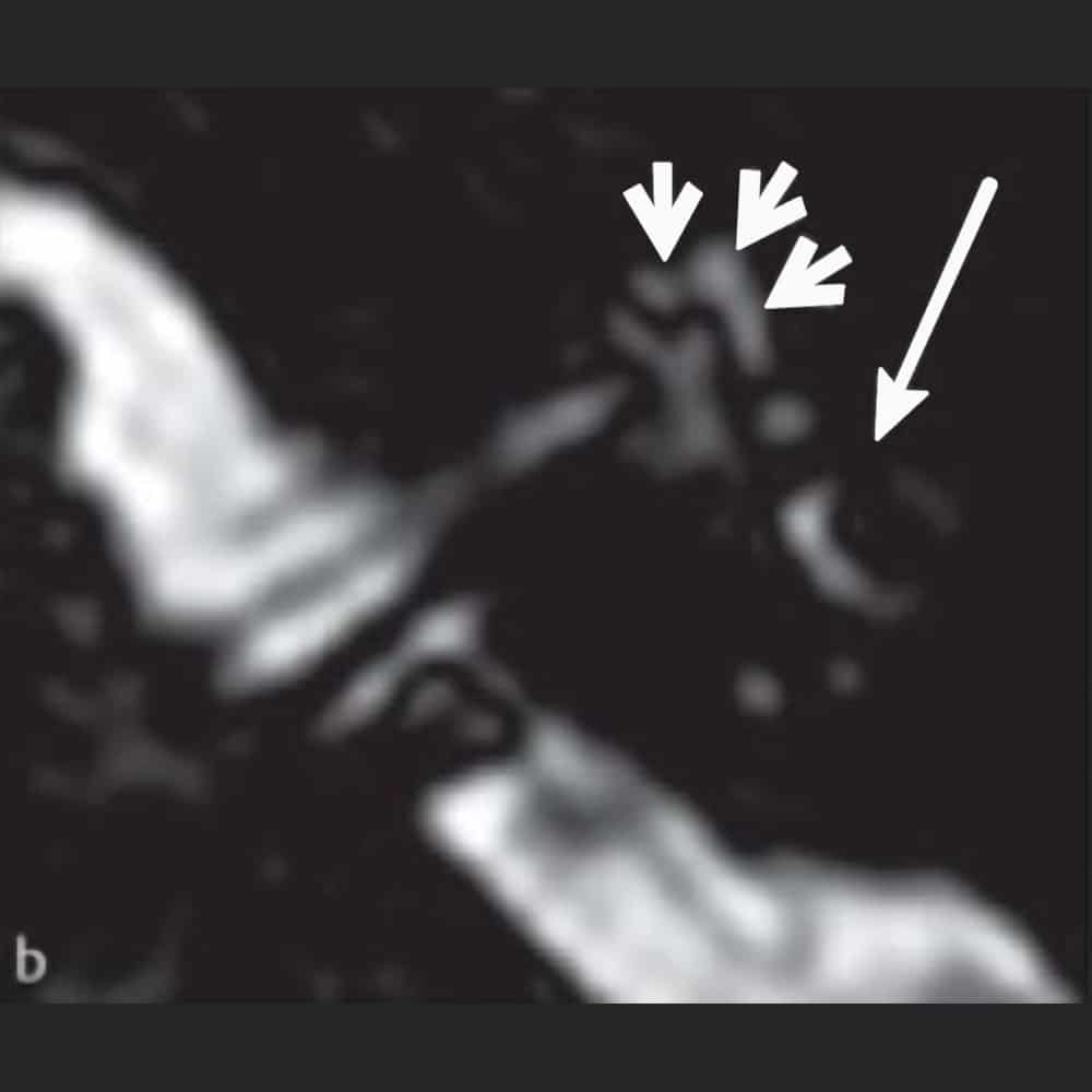 MRI scan of the ear for vertigo