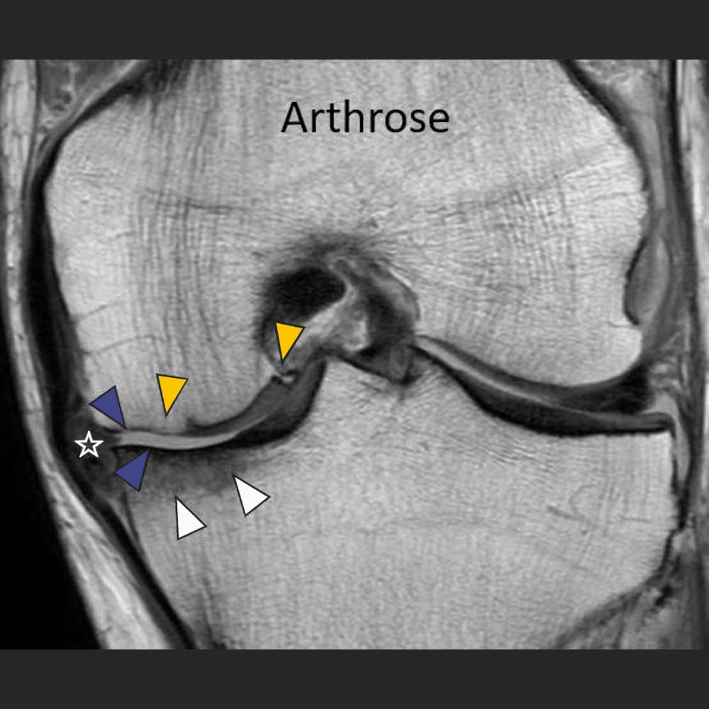 MRI knee for osteoarthritis