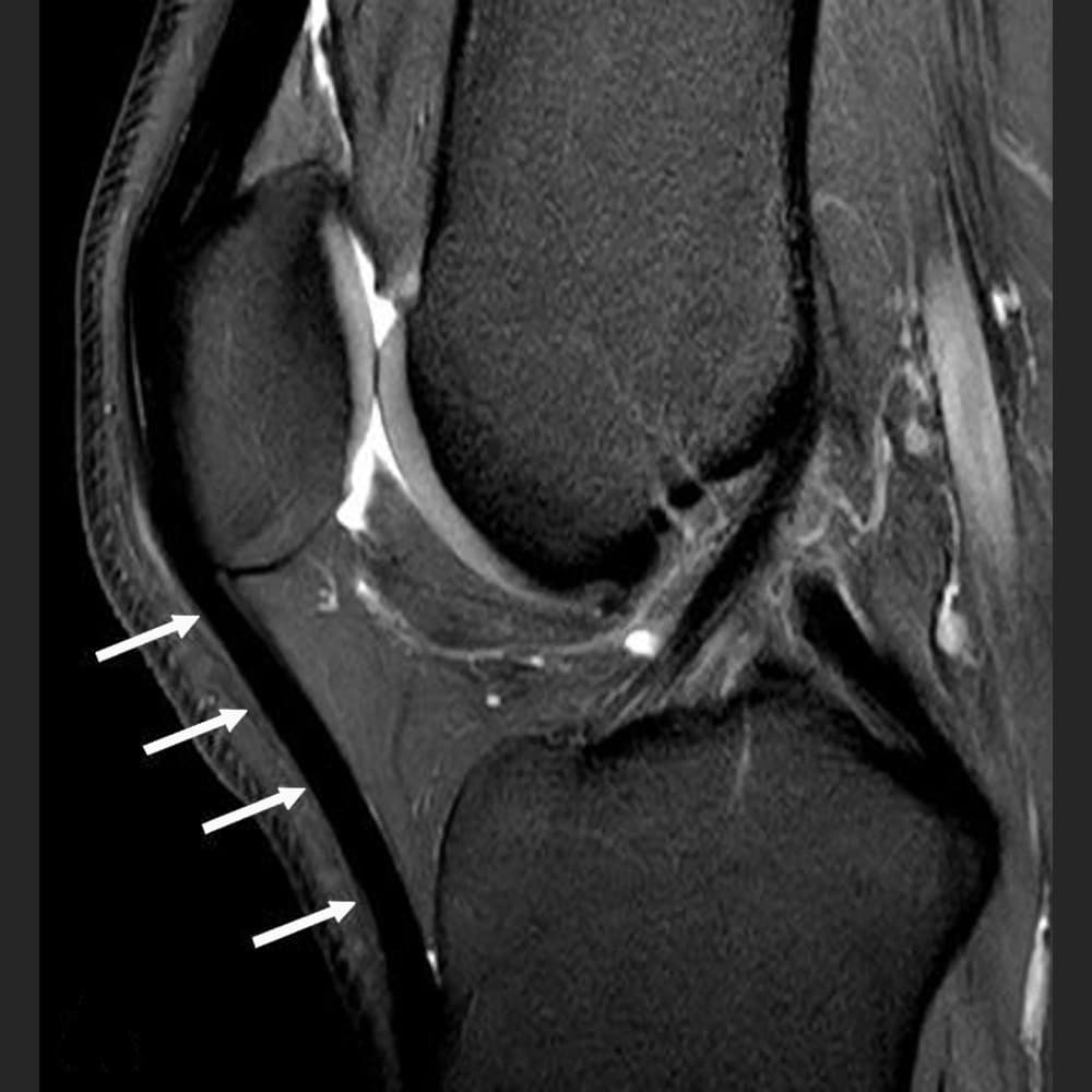 MRI knee of the healthy patellar tendon