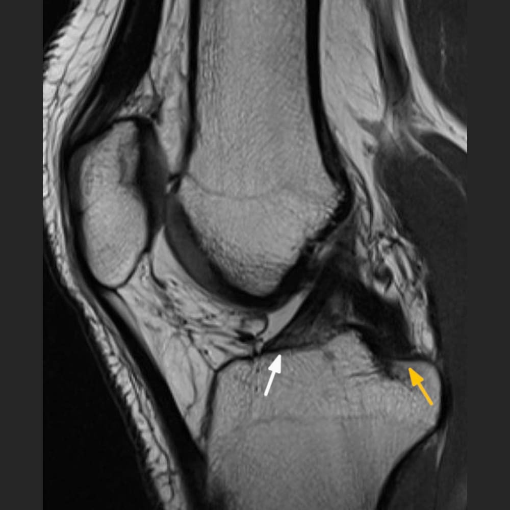 MRI image of a healthy knee