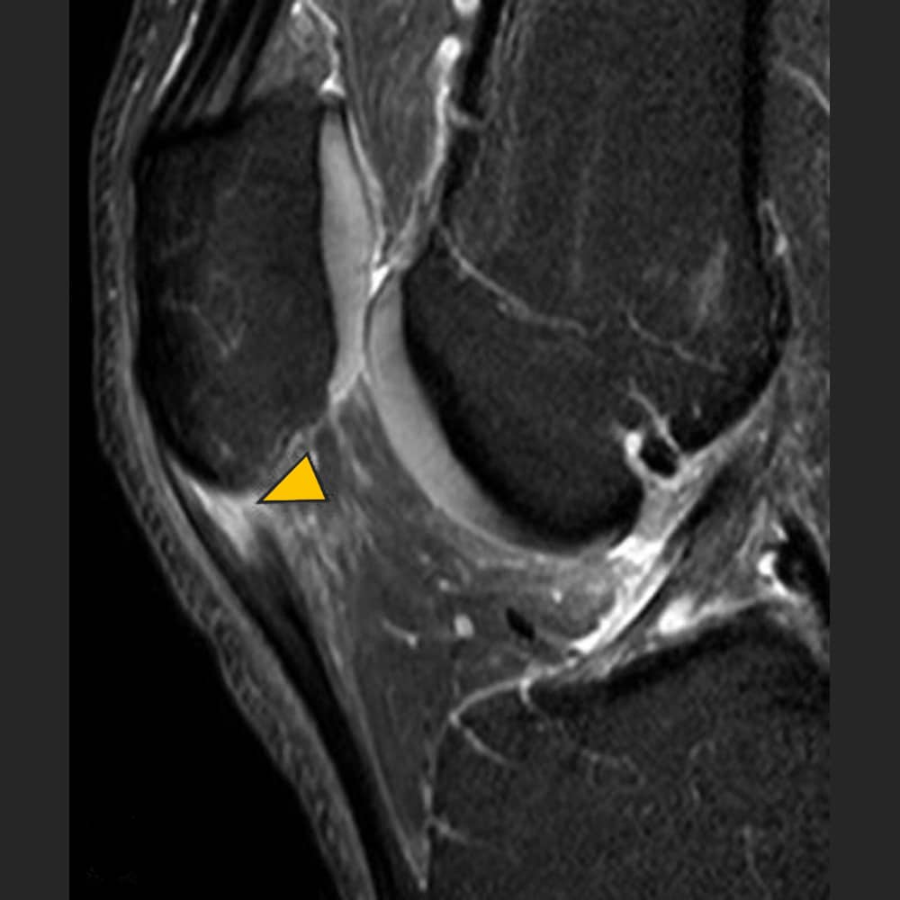 MRI knee. Lateral view of the knee joint