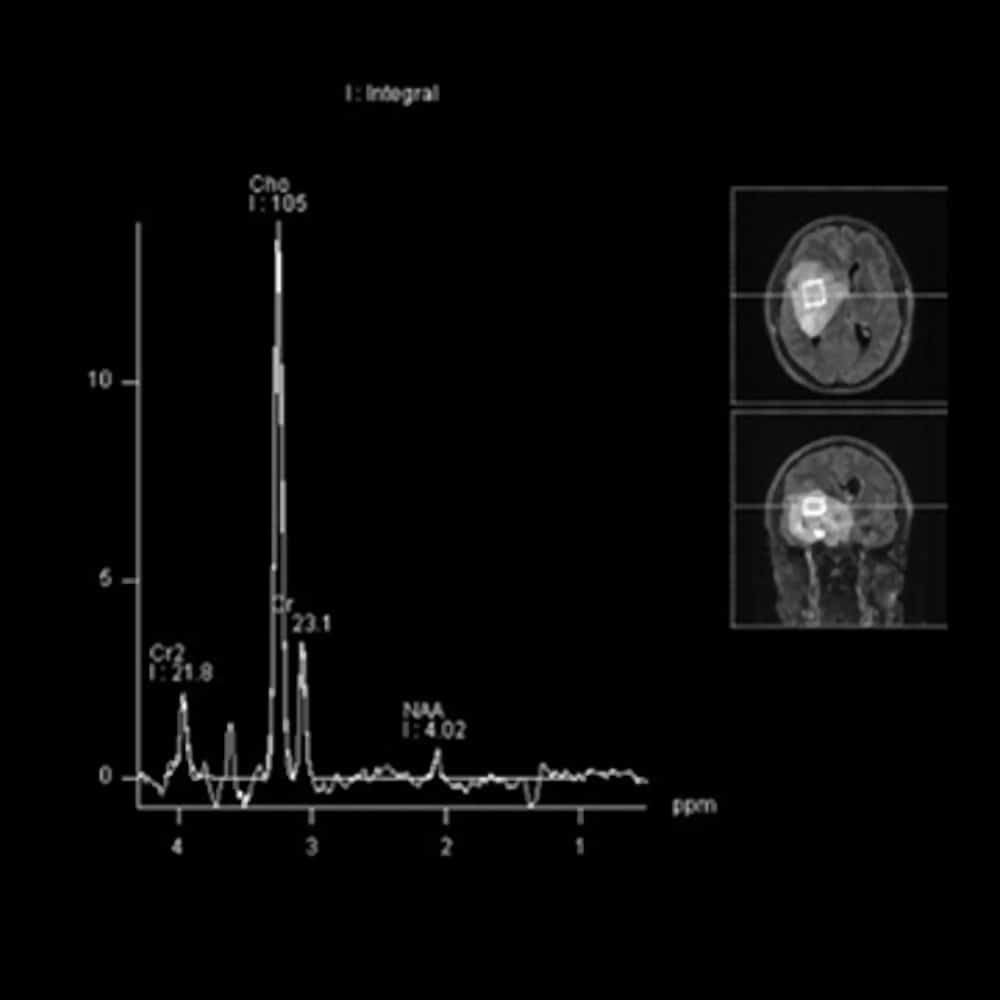 Neurological MRI image for brain tumour