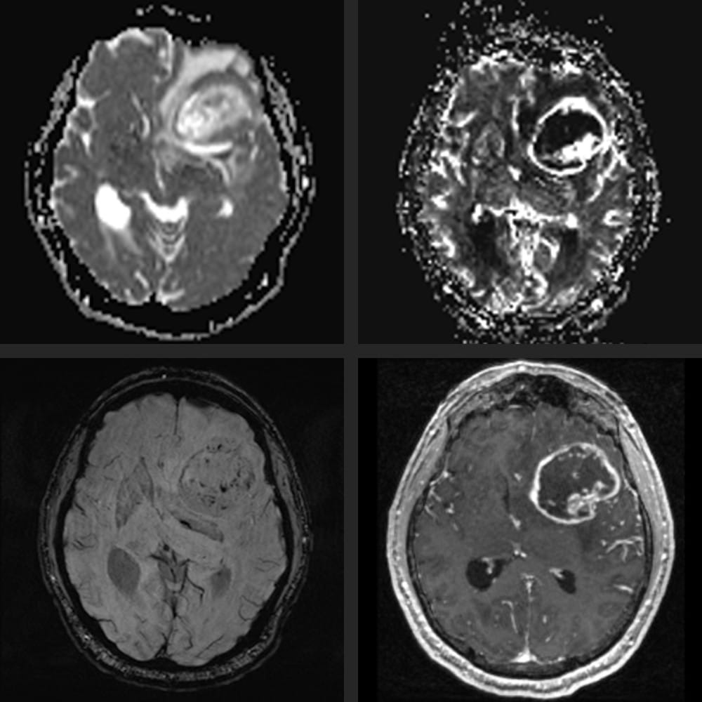 MRI image of brain tumour. Various cross-sections of the brain