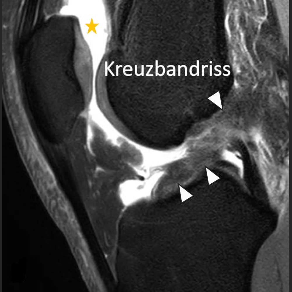 MRI image cruciate ligament rupture