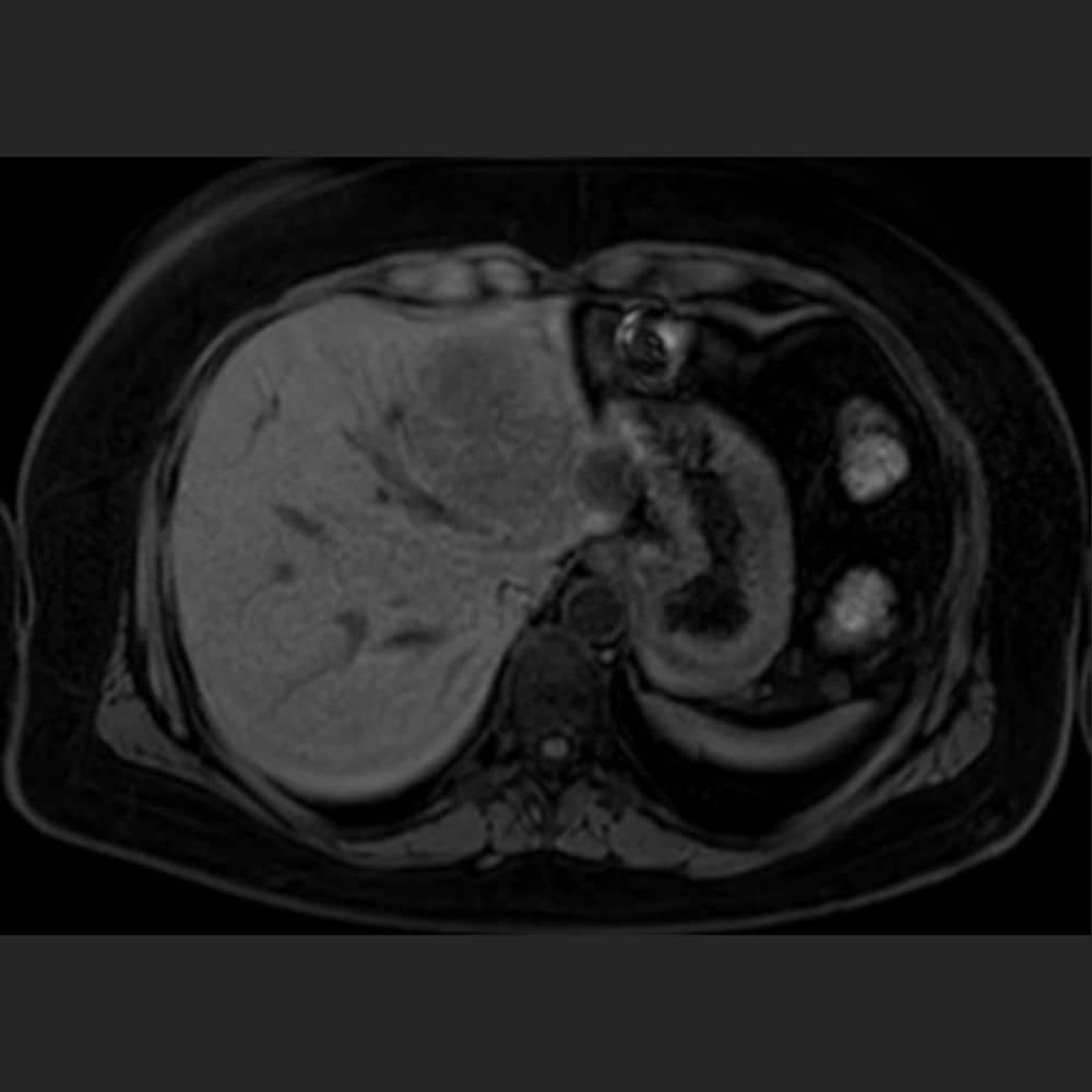 MRI liver without contrast medium
