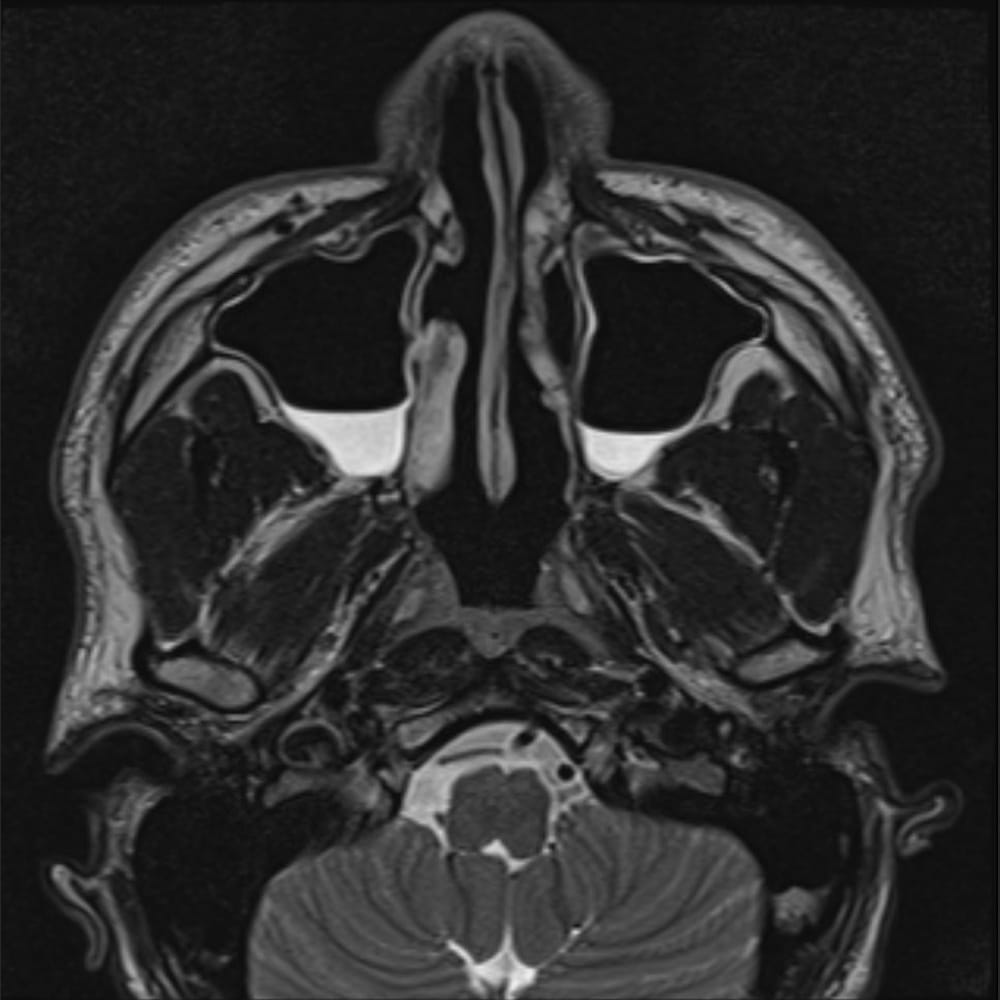 MRI sinus