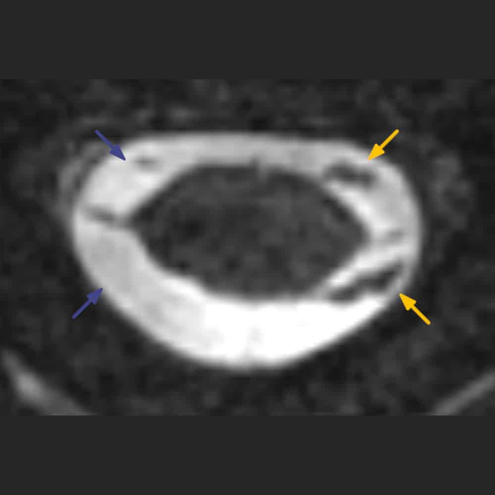 MRI image of the spinal cord and nerve exits