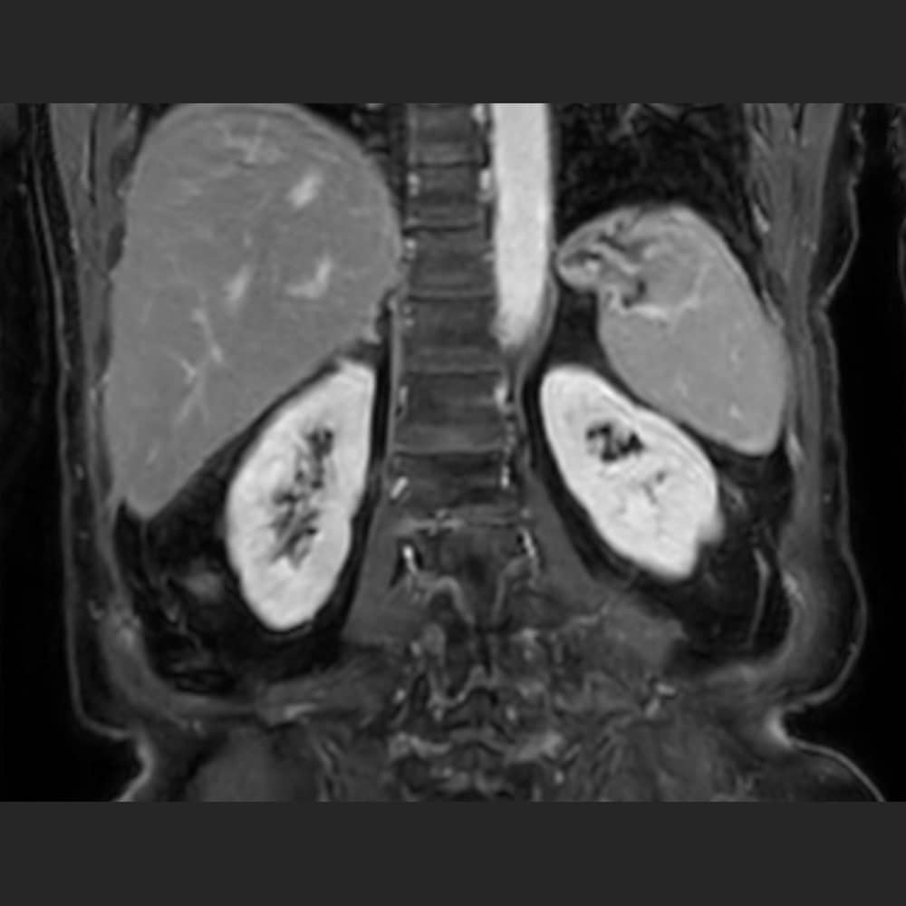 MRI kidneys at ARISTRA