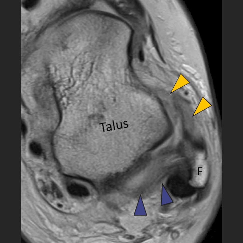 MRI ankle joint, cross-section through the hindfoot with ligament tear