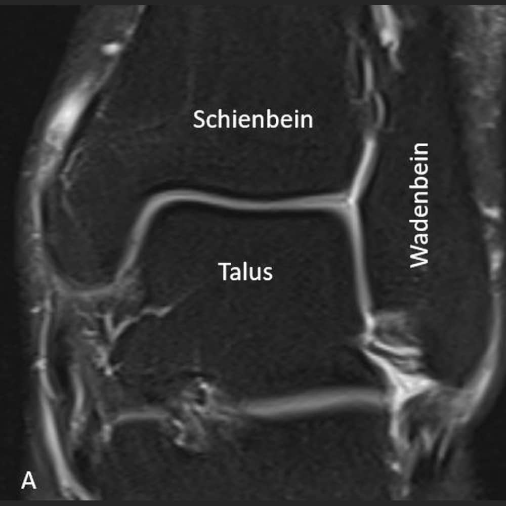 MRI frontal view of the upper ankle joint