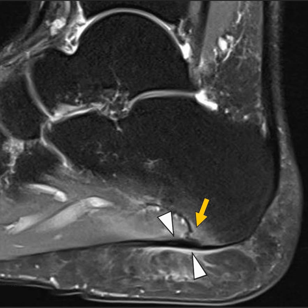 MRI ankle, irritated plantar fascia