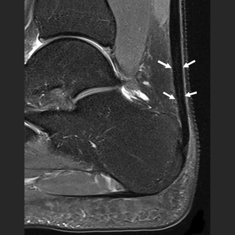 MRI ankle joint, healthy Achilles tendon