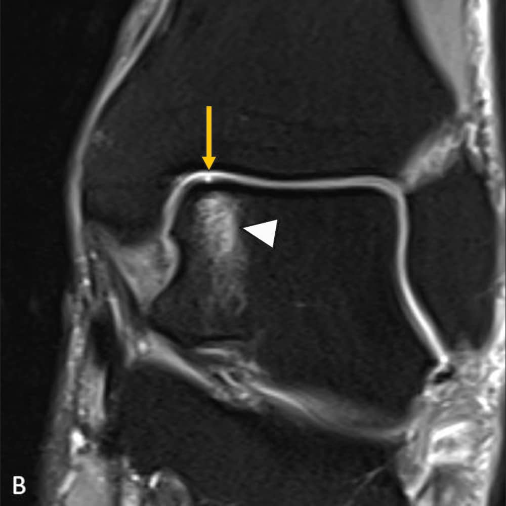 MRI image of the ankle joint, frontal view of the upper ankle joint