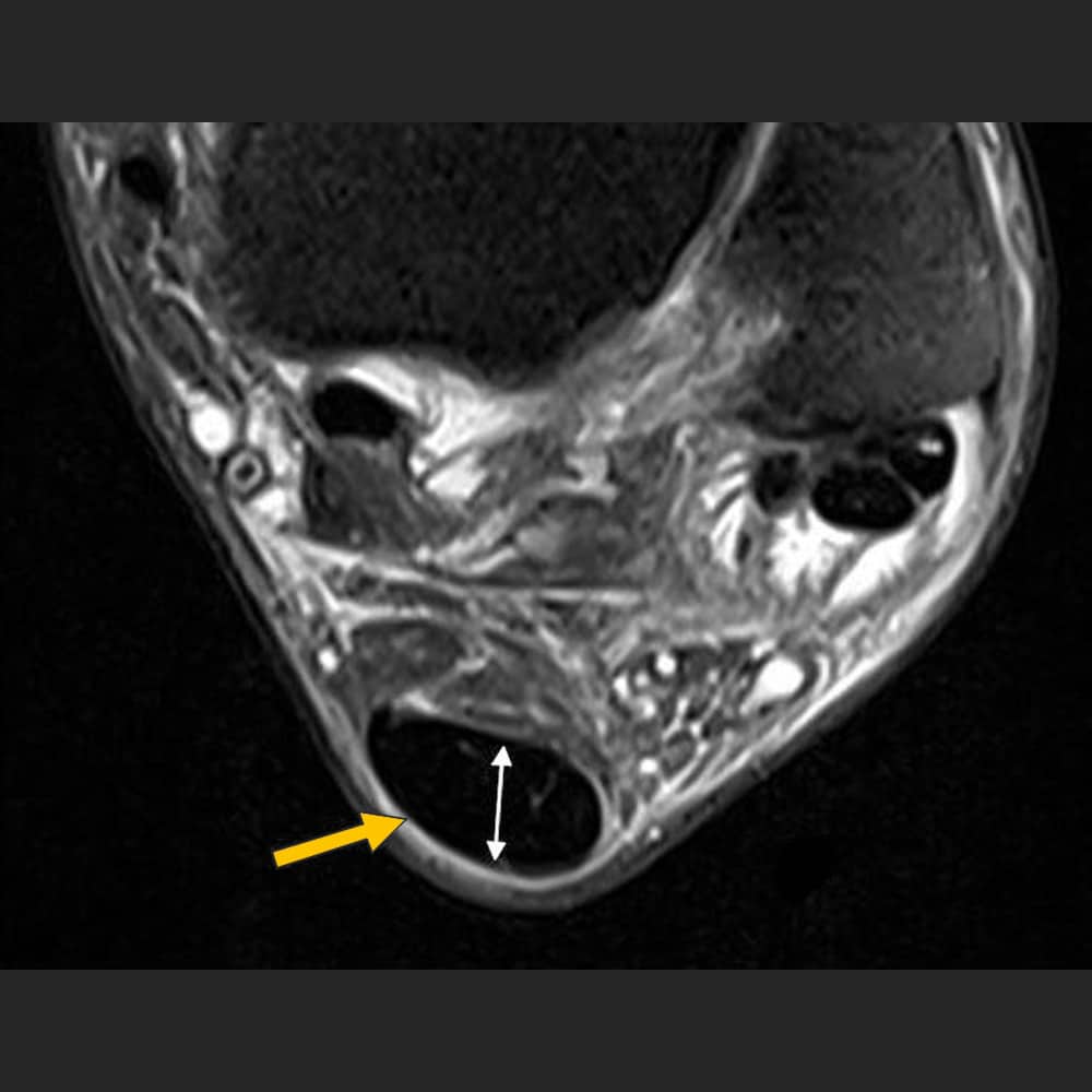 MRI ankle joint transverse section, tendinopathy of the Achilles tendon