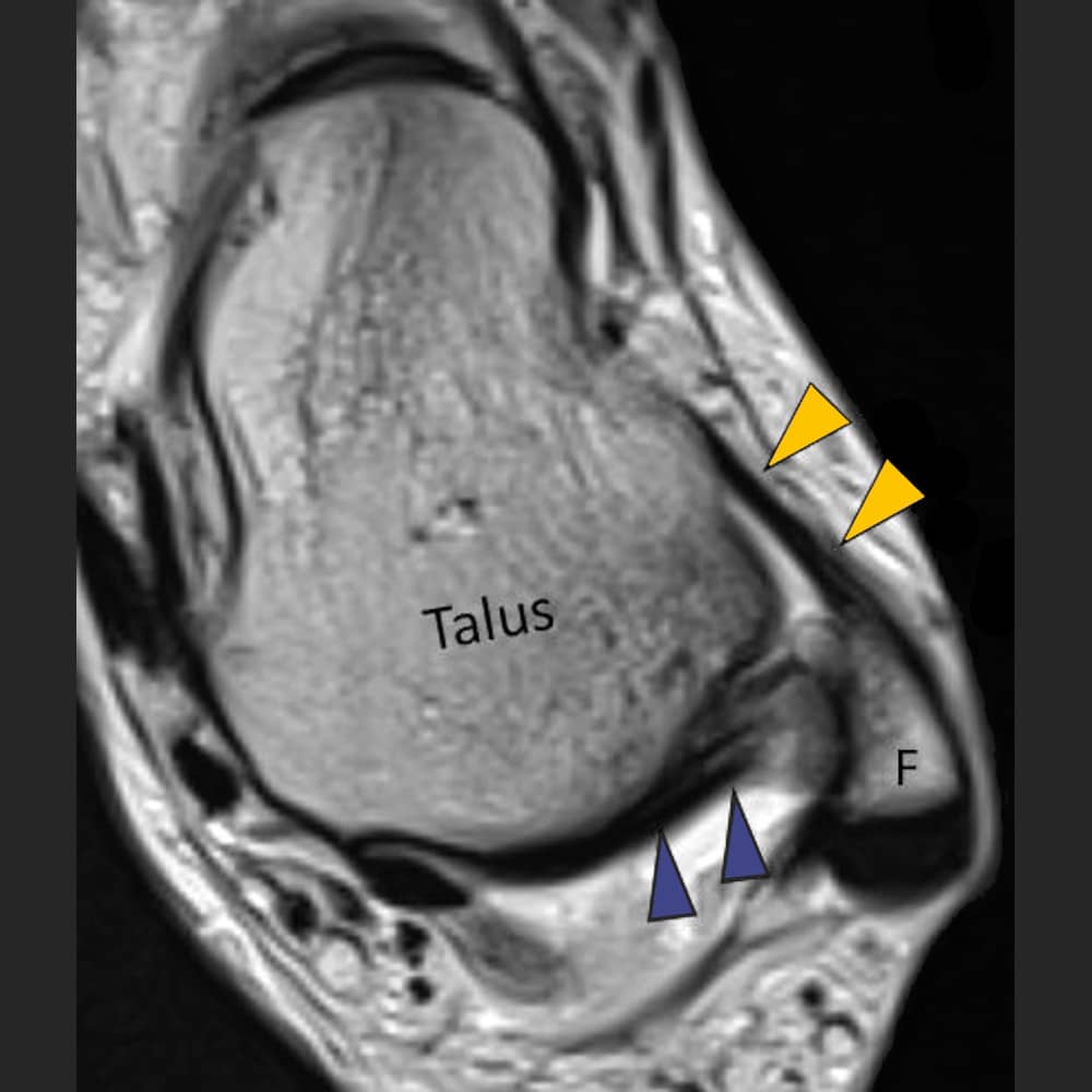 MRI ankle joint, cross-section through the healthy hindfoot