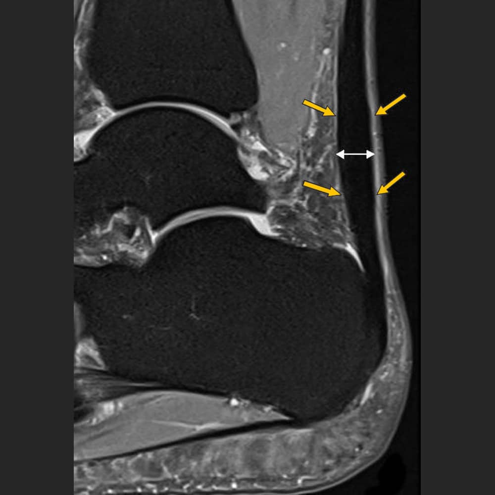 MRI ankle joint, thickened Achilles tendon