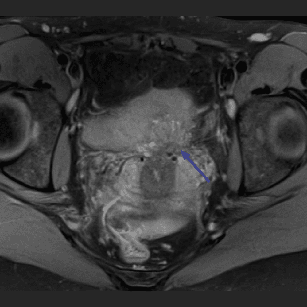 MRI image of the abdomen in endometriosis, cross-section