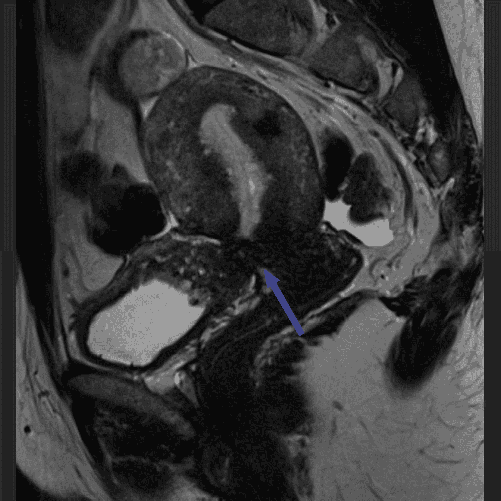 MRI of the female abdomen in endometriosis, lateral view